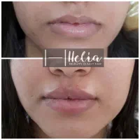 تزریق تخصصی فیلر|خدمات آرایشگری و زیبایی|شیراز, تندگویان|دیوار