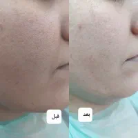 لک جوش و منافذ و جای جوش و لیفت و جوانسازی صورت|خدمات آرایشگری و زیبایی|زاهدان, |دیوار