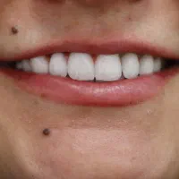 دندانپزشکی اقساطی بدون پیش پرداخت ایمپلنت کامپوزیت