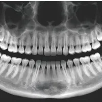 رادیولوژی دندان