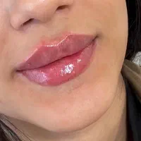 تزریق ژل لب روسی با متد تخصصی روسی و بوتاکس