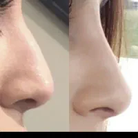 عمل جراحی زیبایی بینی در شمال فقط ۲۷ میلیون