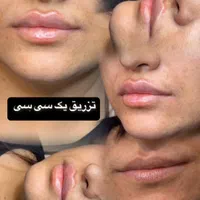 به چند نفر مدل تزریق ژل و بوتاکس نیازمندیم|خدمات آرایشگری و زیبایی|ارومیه, |دیوار