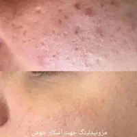 مزونیدلینگ کل صورت و پاکسازی وخالبرداری وآموزش|خدمات آرایشگری و زیبایی|یزد, |دیوار
