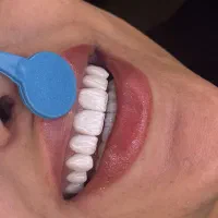 کامپوزیت ایمپلنت لمینت اقساط ویژه