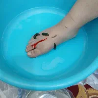 خدمات حجامت .فصد.زالودرمانی در محل شما