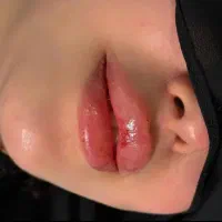 ژل وبوتاکس تخفیف ۵۰درصدی فقط سی سی ۵۵۰