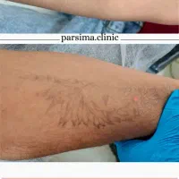 ریموو تتو و لک صورت و خالبرداری