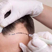 استخدام تکنیسین کاشت مو و ابرو