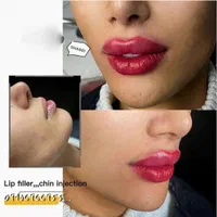 جشنواره تزریق ژل و بوتاکس و آموزش|خدمات آرایشگری و زیبایی|اصفهان, بهار آزادی|دیوار