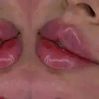 خدمات ژل فیلر بوتاکس آف سه روزه مواد امریکایی