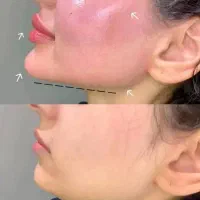 ژل و بوتاکس باقیمت استثنایی|خدمات آرایشگری و زیبایی|بروجرد, |دیوار