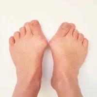 مرکزتخصصی درمان هالوکس والگوس (شصت پای کج)