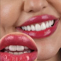 طراحی لبخند،کامپوزیت با ظاهر کاملا طبیعی