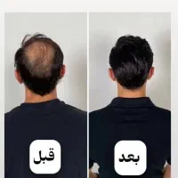 درمان ریزش مو در ۷ روز