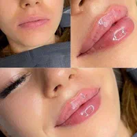 ژل فیلر بوتاکس مزو هایفو لب