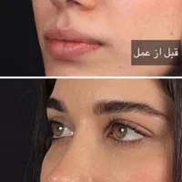 جراحی زیبایی بینی فقط با 22 ملیون|خدمات آرایشگری و زیبایی|شاهرود, |دیوار