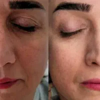 خدمات زیبایی جوانسازی و فیشال و رفع لک و منافذ