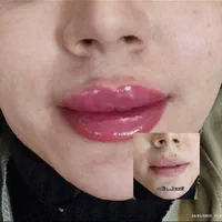 ژل وبوتاکس.چربی سوز.انزیم.فشیال.پیرسینگ|خدمات آرایشگری و زیبایی|اصفهان, احمدآباد|دیوار