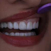 لمینیت دندان نظرآباد / دکتر حسینی