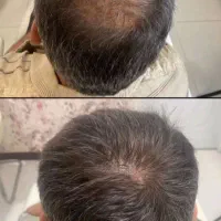 سبوس برنج ضدریزش مو