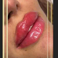 ژل لب و چانه و بوتاکس و نخ و لیزر و لیزر موهای بدن