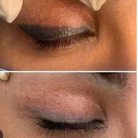 تخفیف ویژه ی آموزش پاک کردن تتو