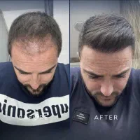 مشاوره کاشت مو،ابرو و کلیه خدمات زیبایی رایگان|خدمات آرایشگری و زیبایی|مشهد, فرهنگ|دیوار