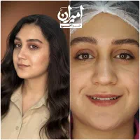 عمل بینی/ جراحی بینی|خدمات آرایشگری و زیبایی|شیراز, تاچارا|دیوار