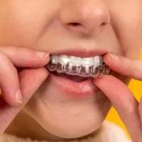 ارتودنسی نامرئی/ارتودنسی اقساطی