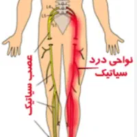 درمان درد سیاتیک و دیسک کمر