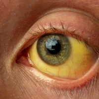 درمان زردی و یرقان وجا انداختن ناف