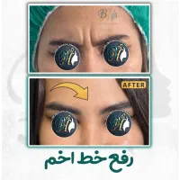 تزریق بوتاکس توسط پزشک در‌ کلینیک زیبایی گلسار رشت