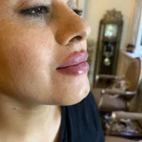 تزریق ژل و بوتاکس فقط۷۵۰|خدمات آرایشگری و زیبایی|هشتگرد, شهرک راه آهن|دیوار