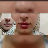 مدل فیلر برای عکاسی