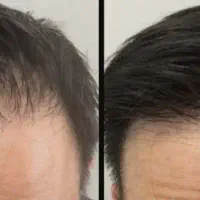 پی آرپی و مزو تراپی و برداشتن خال
