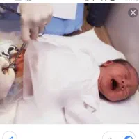 ختنه اطفال بدون درد د خونریزی