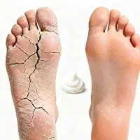 درمان قطعی ترک پا