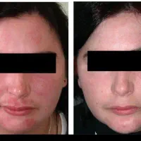 لک و التهاب‌های عجیب پوستت تکرار می‌شن
