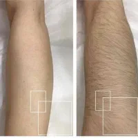 جشنواره لیزر حذف موهای زائد فول ۴۵۰