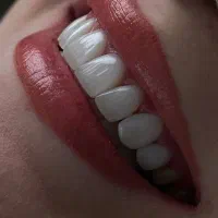مرکزکاشت ایمپلنت و زیبایی دندان با٪۳۰تخفیف