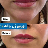 ریموو تاتو/ریزش سکه ای/مزوتـراپی/خال بـرداری/فیشال|خدمات آرایشگری و زیبایی|شیراز, طلاب|دیوار