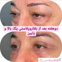 تخفیف استثنایی بلفاروپلاستی،بوکال فت،ساکشن غبغب|خدمات آرایشگری و زیبایی|تهران, فرمانیه|دیوار