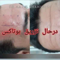 مطب زیبایی دکتر کژال شاه ویسی تزریق ژل بوتاکس..