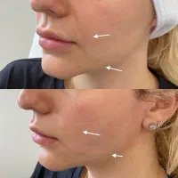 مدل لیفت صورت و ابرو با نخ توسط پزشک در کلینیک|خدمات آرایشگری و زیبایی|تهران, علم و صنعت|دیوار