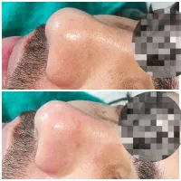 پاکسازی و فیشال پوست