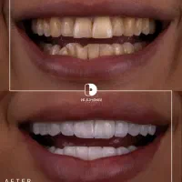 کامپوزیت/لمینت/دندانپزشکی|خدمات آرایشگری و زیبایی|مشهد, کوثر|دیوار