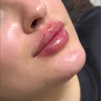 تزریق ژل صورت..بدن..بوتاکس در مطب توسط پزشک