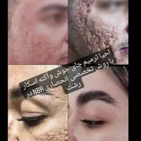 بازسازی درمان جای جوش آکنه باروش تخصصی NBR در کشور|خدمات آرایشگری و زیبایی|رشت, فلسطین|دیوار