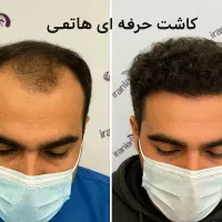 کلینیک کاشت مو